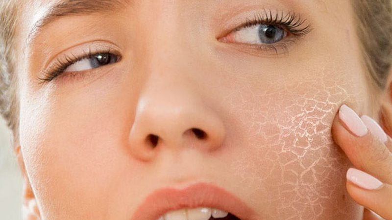 Что вызывает сухость кожи и как ее лечить
