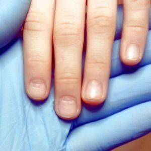 Ломкие ногти: симптомы, причины и лечение
