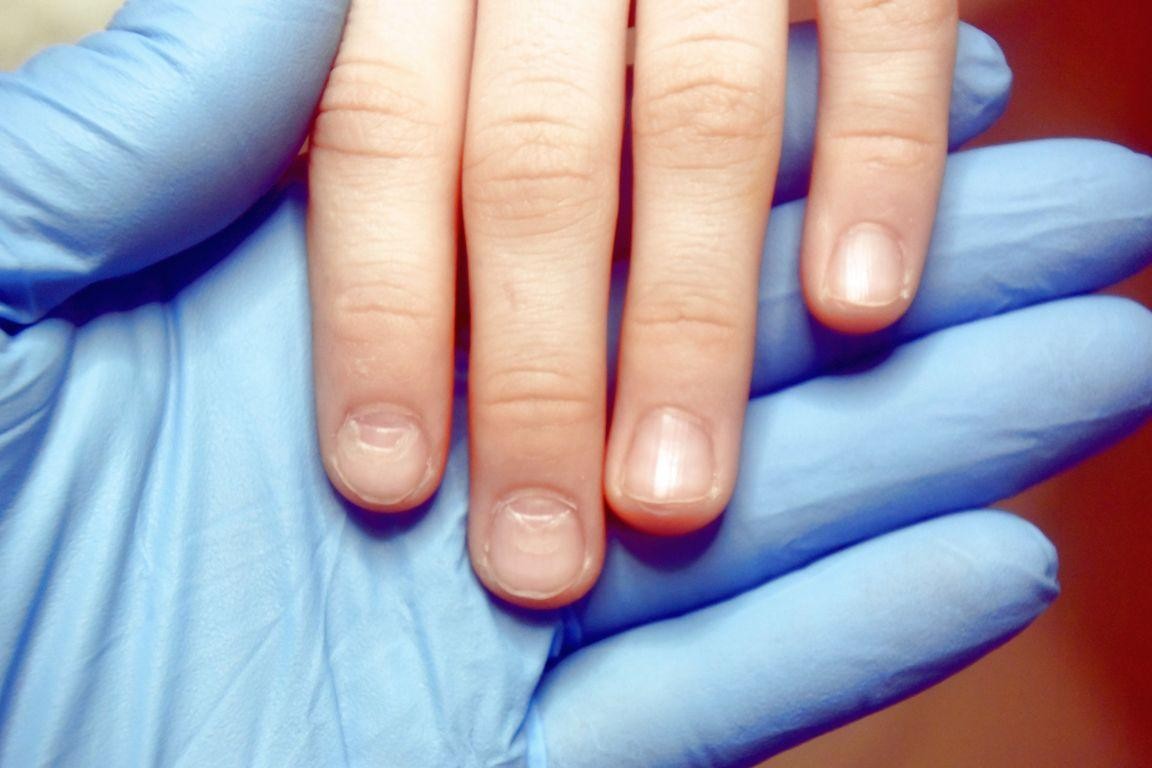 Ломкие ногти: симптомы, причины и лечение